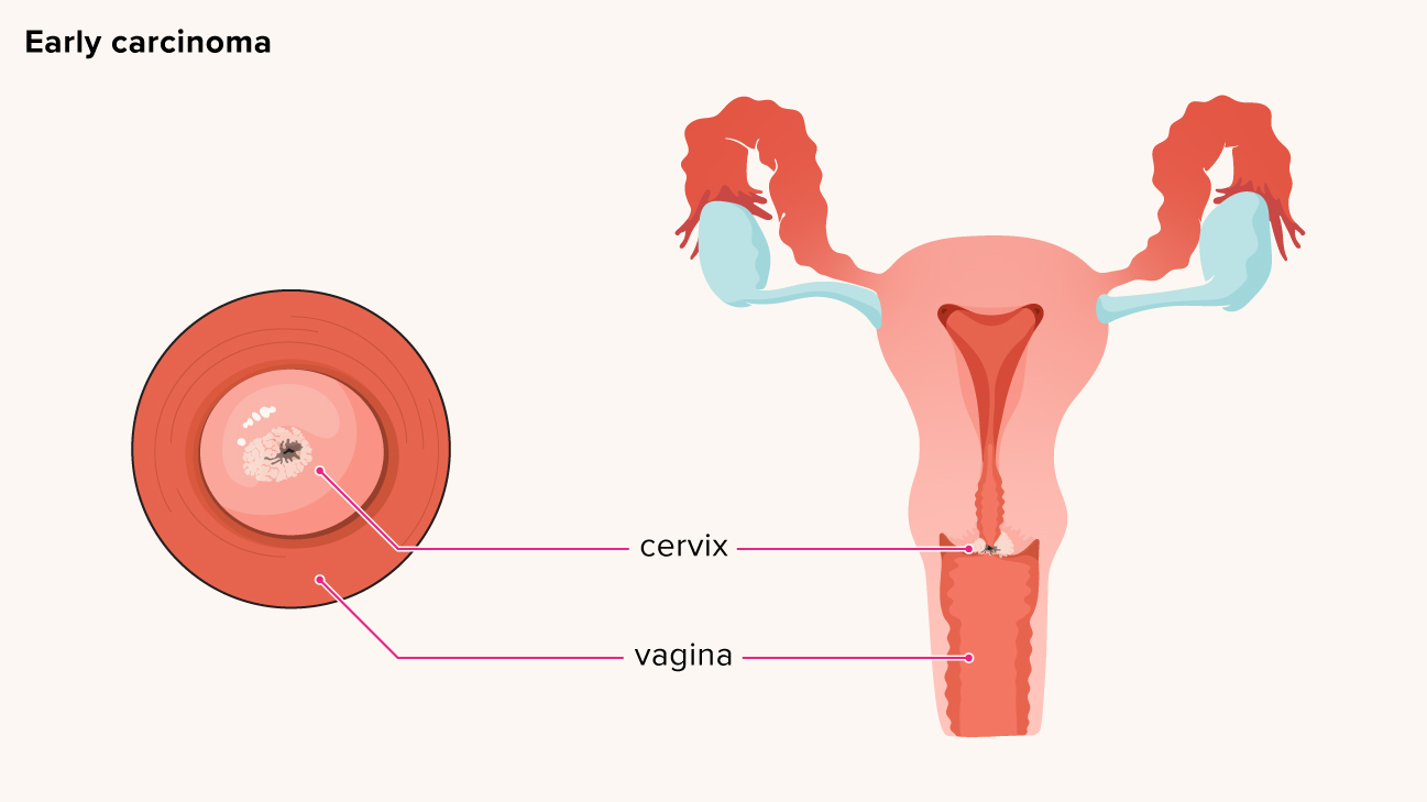 Cancer of the cervix or cervix