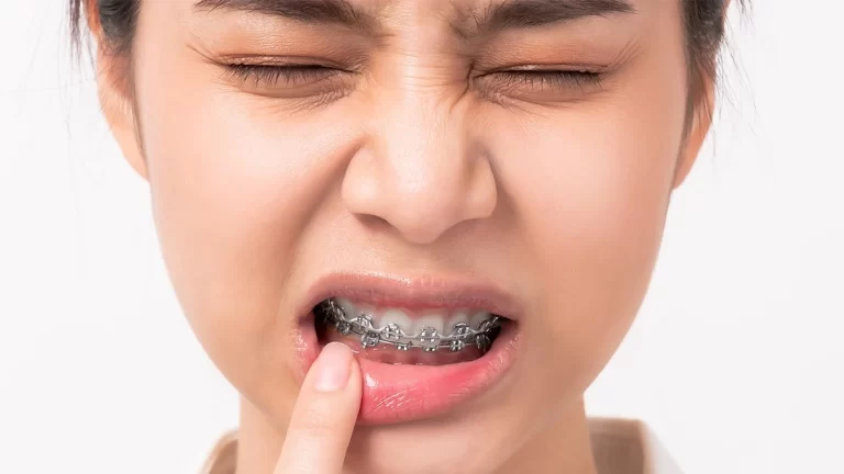 Do Getting Braces Hurt? What to Anticipate